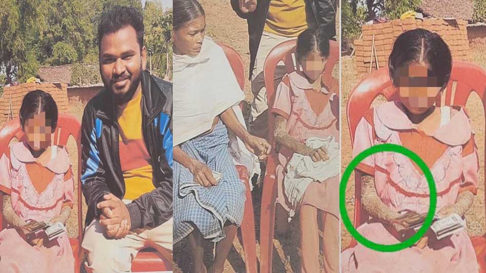 पत्थर जैसी बन रही बच्ची का होगा इलाज, बाल आयोग ने मामले में दिखाई सक्रियता
